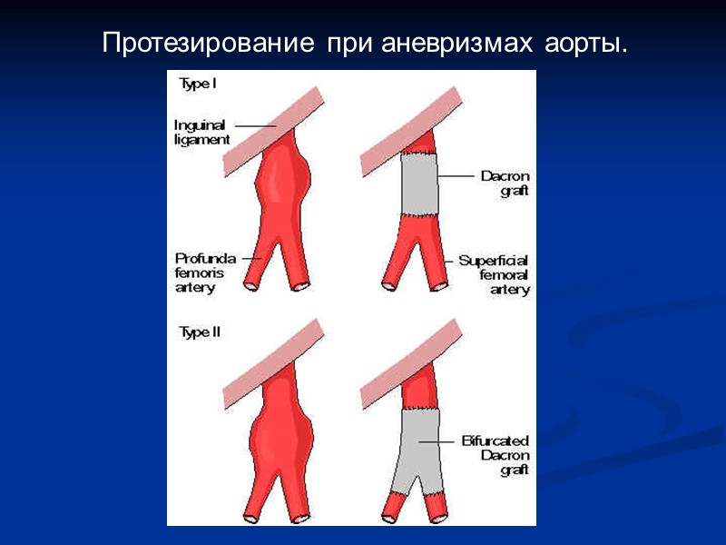 Протезирование при аневризмах аорты.